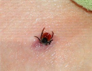 Як витягнути кліща у людини в домашніх умовах: методи вилучення з тіла людини