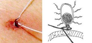 Як витягнути кліща у людини в домашніх умовах: методи вилучення з тіла людини