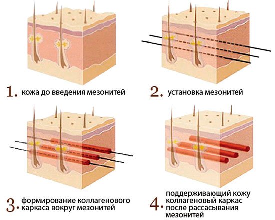 Що таке мезонити: відгуки, фото до і після