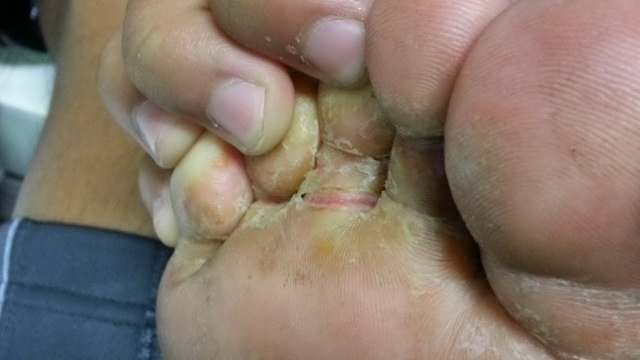 Грибок на тілі   типи грибка, симптоми, причини, профілактика