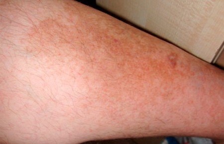 Пігментні плями на ногах: причини, фото, лікування