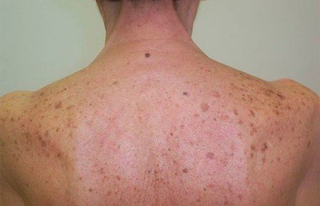 Пігментні плями на спині: причини, види, як позбутися