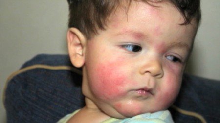 Алергія на мед: симпотомы, лікування і як проявляється (фото)