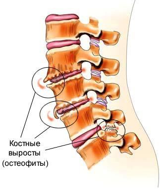 Остеофіти: причини, види та лікування