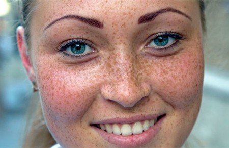 Пігментні плями на обличчі: причини і лікування