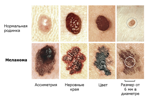 Що таке родимки і як вони зявляються на тілі