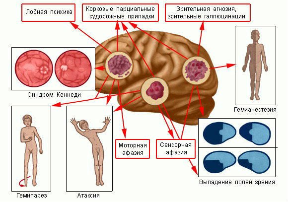 Рак головного мозку 4 стадії: ознаки, методи лікування та прогноз