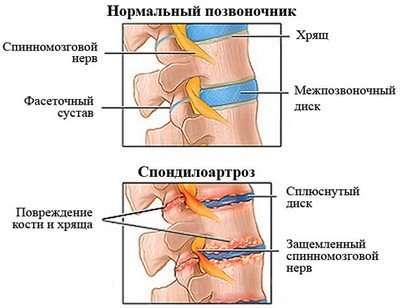 Спондилоартроз поперекового відділу хребта: симптоми і лікування