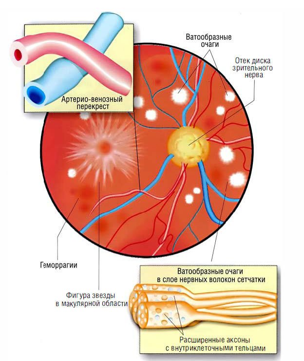 Що таке ангіопатія судин сітківки ока?