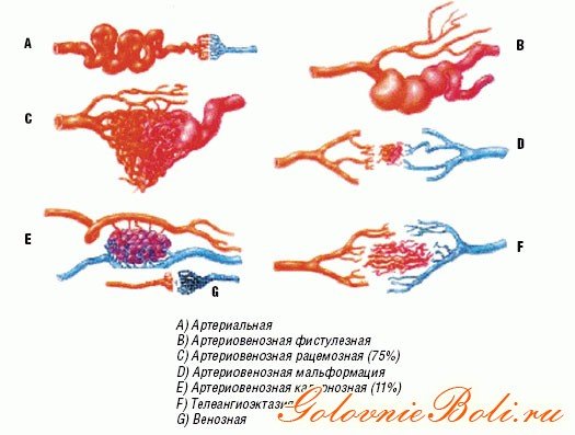 Гемангіома головного мозку у дорослих, лікування новоутворень кавернозних