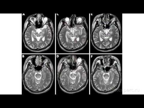 Кіста головного мозку: види, симптоми і лікування.
