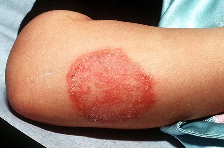 Грибок на тілі   типи грибка, симптоми, причини, профілактика