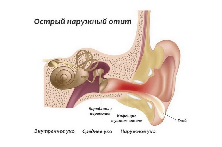 Гострий зовнішній отит   причини, симптоми, лікування