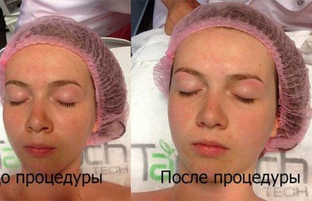 Комбінована чистка обличчя: відгуки, фото до і після