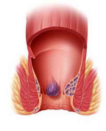 Геморой: симптоми захворювання