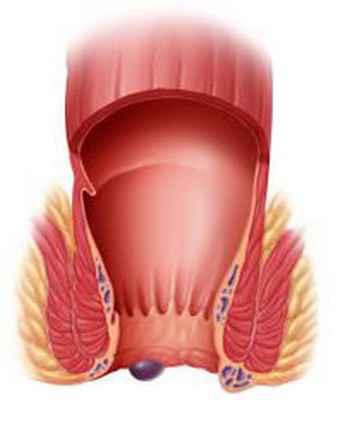 Геморой: симптоми захворювання