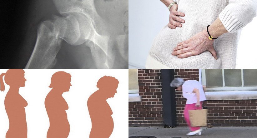 Остеопороз   причини, симптоми, методи лікування