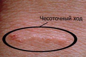 Як виглядає коростяний кліщ: фото, як позбавитися, укуси, лікування
