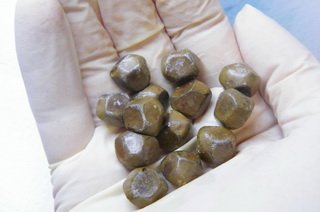 Жовчнокамяна хвороба   причини, симптоми, лікування, профілактика