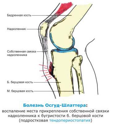 Hvoroba Osgud Shlyattera Zdorov Ya