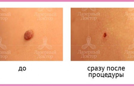 Видалення родимок лазером: відгуки, наслідки, фото і опис