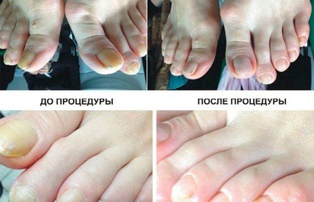 Апаратний педикюр: що це, відгуки, фото