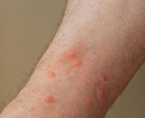 Чи небезпечні блохи для людини: що важливо знати