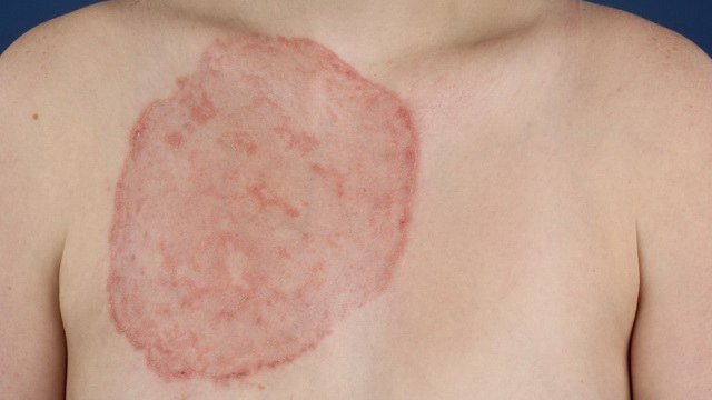 Грибок на тілі   типи грибка, симптоми, причини, профілактика