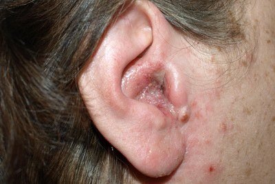 Отомикоз   причини, симптоми, лікування