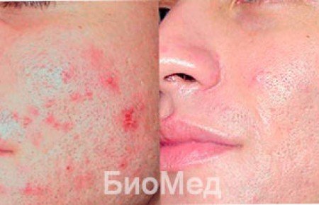 Ультразвуковий пілінг обличчя: що це таке, відгуки, фото