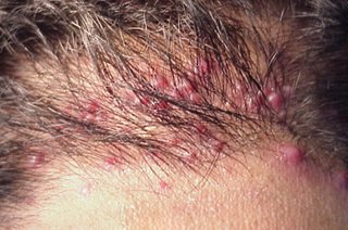 Трихомоніаз на голові   причини і лікування