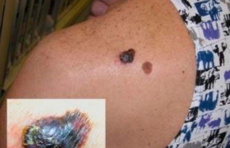 Пігментні плями на спині: причини, види, як позбутися