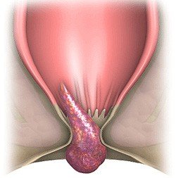 Внутрішній геморой   симптоми і лікування