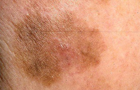 Пігментні плями на спині: причини, види, як позбутися