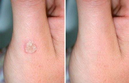 Видалення папілом в домашніх умовах Видалення папілом в домашніх умовах