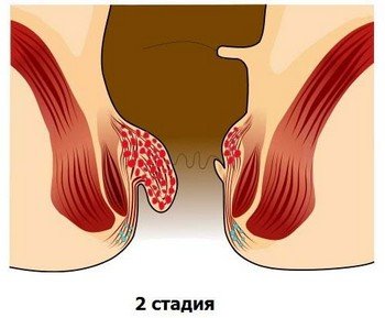 Стадії геморою, їх симптоми та лікування