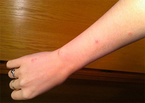 Укуси бліх на людину: детальні фото та опис симптомів