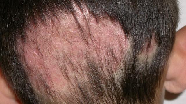 Грибок на тілі   типи грибка, симптоми, причини, профілактика