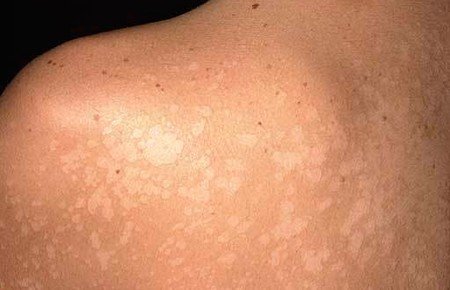 Пігментні плями на спині: причини, види, як позбутися