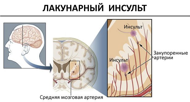 Лакунарный інсульт : причини, симптоми, діагностика і лікування