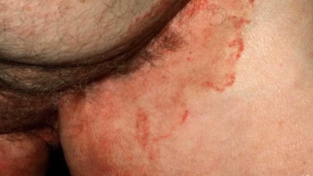 Грибок на тілі   типи грибка, симптоми, причини, профілактика