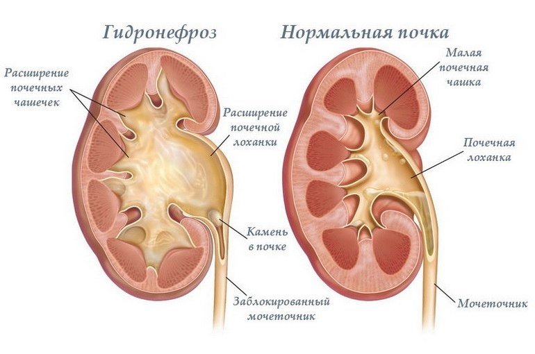 Гідронефроз   причини, симптоми, лікування, діагностика