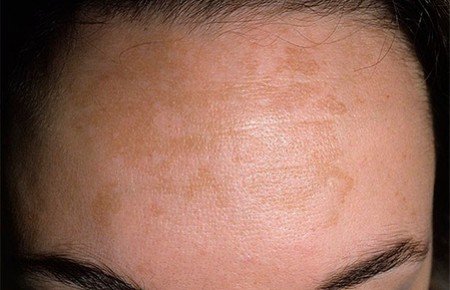 Пігментні плями на обличчі: причини і лікування