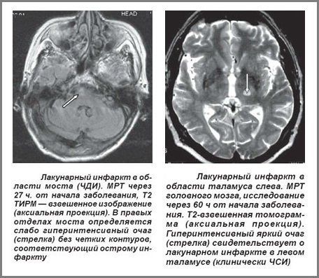 Лакунарный інсульт : причини, симптоми, діагностика і лікування