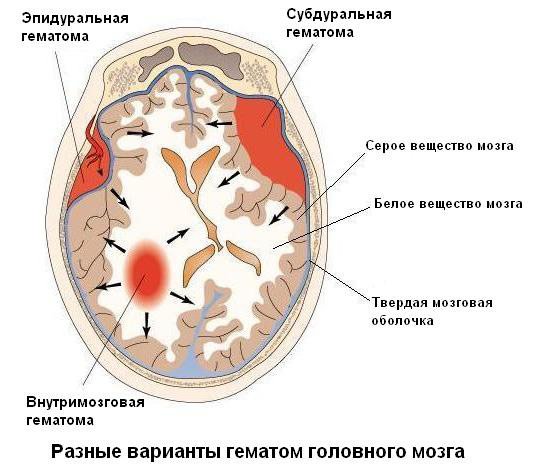 Гематома головного мозку