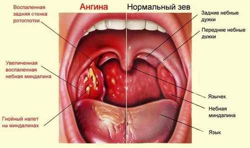 Чим полоскати горло при ангіні: аптечні і народні засоби
