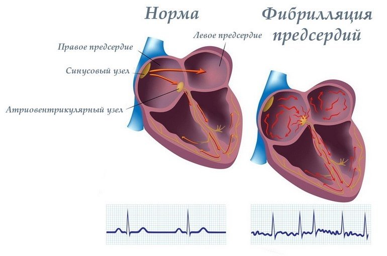 Фібриляція передсердь   причини, симптоми, методи лікування