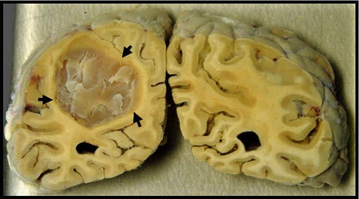 Пухлина головного мозку: причини, симптоми і лікування