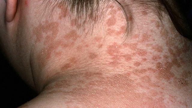 Грибок на тілі   типи грибка, симптоми, причини, профілактика