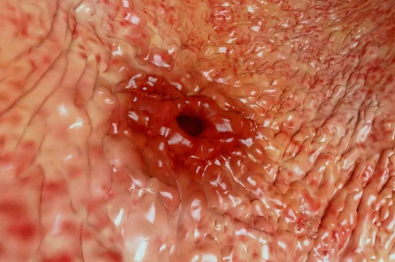 Виразка шлунка і дванадцятипалої кишки   причини, симптоми, лікування